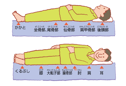 床ずれのできやすいところ